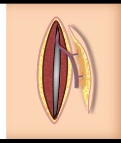 Lower Extremity